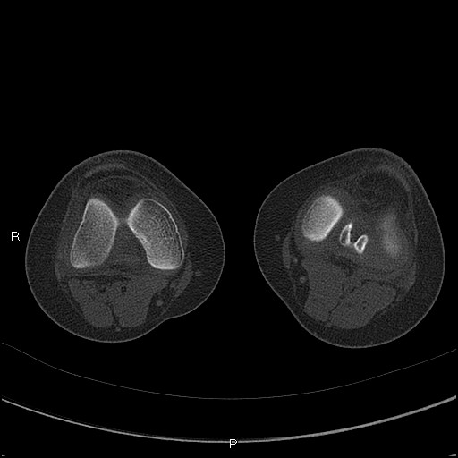 Chondroblastoma (Radiopaedia 62721-71030 Axial bone window 31).jpg