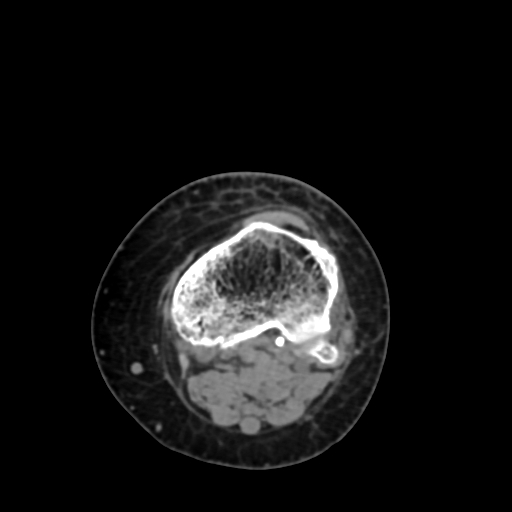 Chondrosarcoma - femur (Radiopaedia 64187-72954 Axial non-contrast 68).jpg