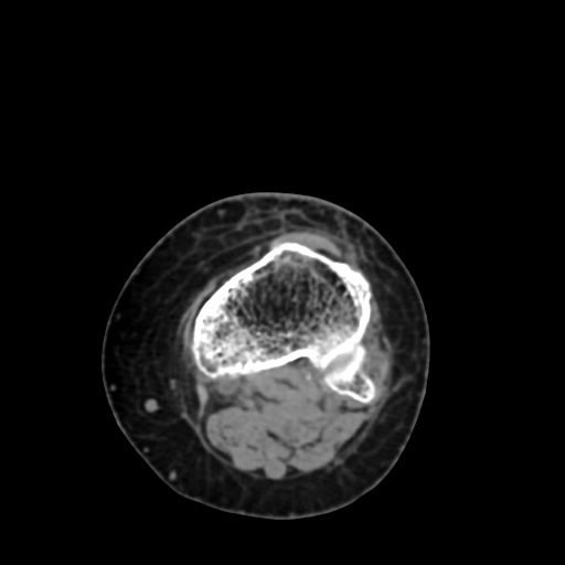 File:Chondrosarcoma - femur (Radiopaedia 64187-72954 Axial non-contrast 69).jpg
