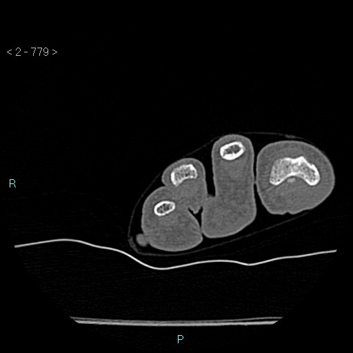 Chondrosarcoma - phalanx (Radiopaedia 69047-78812 Axial bone window 33).jpg