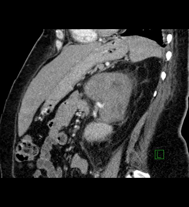 Chromophobe renal cell carcinoma (Radiopaedia 84239-99519 D 45).jpg
