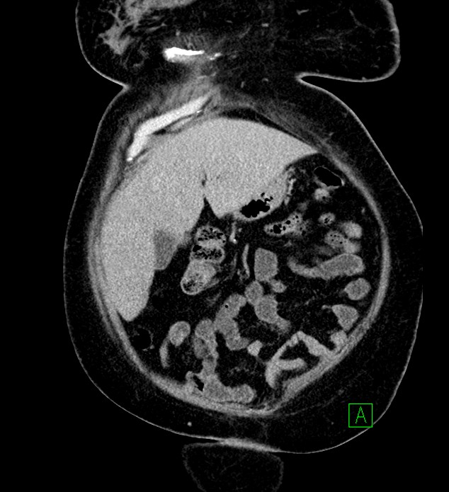 Chromophobe renal cell carcinoma (Radiopaedia 84239-99519 F 20).jpg