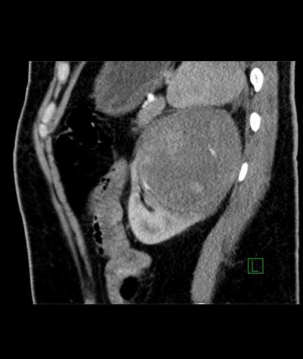 Chromophobe renal cell carcinoma (Radiopaedia 84255-99542 E 15).jpg