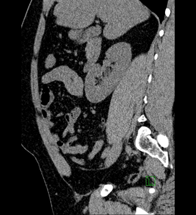 Chromophobe renal cell carcinoma (Radiopaedia 84286-99573 C 117).jpg