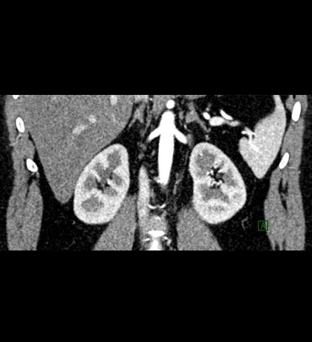 Chromophobe renal cell carcinoma (Radiopaedia 84286-99573 E 51).jpg