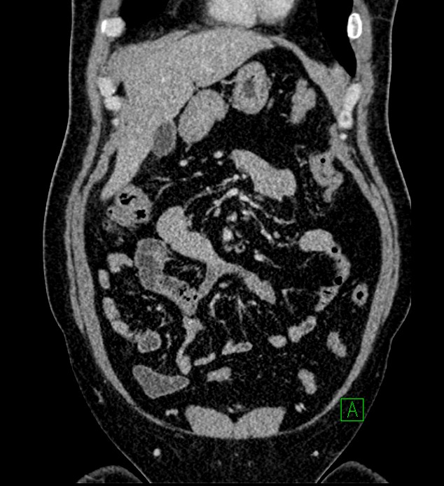 Chromophobe renal cell carcinoma (Radiopaedia 84286-99573 H 50).jpg