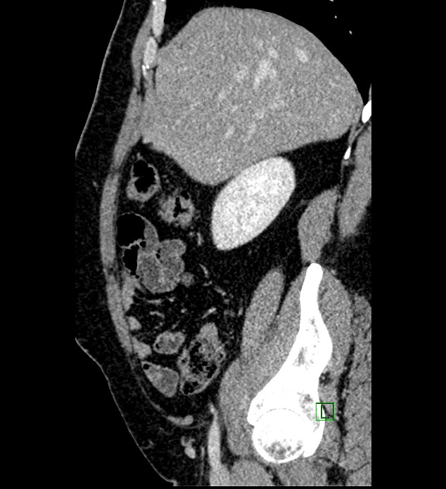 Chromophobe renal cell carcinoma (Radiopaedia 84286-99573 I 139).jpg
