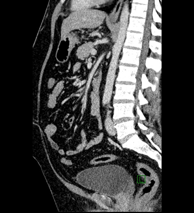 Chromophobe renal cell carcinoma (Radiopaedia 84286-99573 I 87).jpg