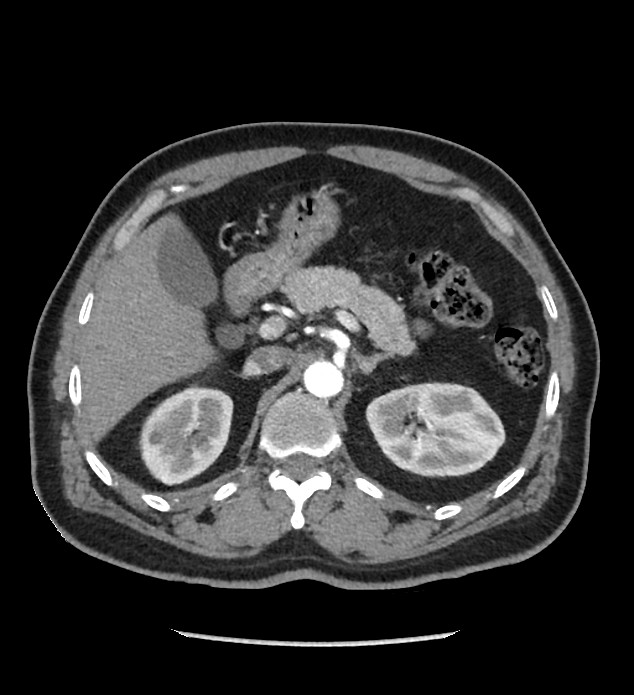 Chromophobe renal cell carcinoma (Radiopaedia 86879-103083 B 45).jpg
