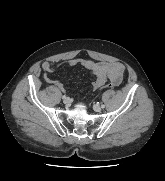 Chromophobe renal cell carcinoma (Radiopaedia 86879-103083 C 119).jpg