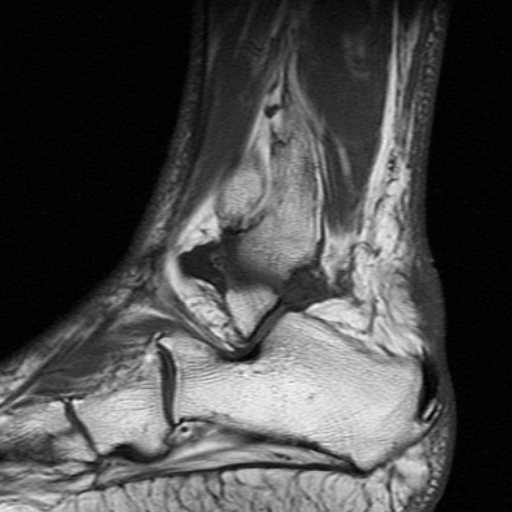 File:Chronic Achilles tendon rupture (Radiopaedia 15262-15100 Sagittal T1 3).jpg