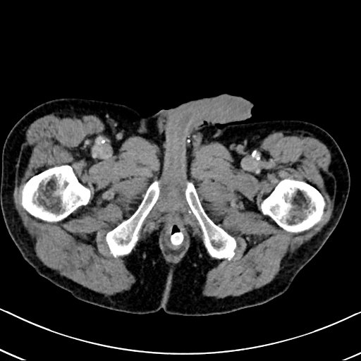 Chronic appendicitis complicated by appendicular abscess, pylephlebitis and liver abscess (Radiopaedia 54483-60700 B 157).jpg