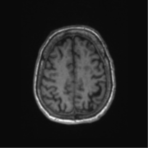 Chronic hypertensive encephalopathy (Radiopaedia 72844-83495 Axial T1 19).png