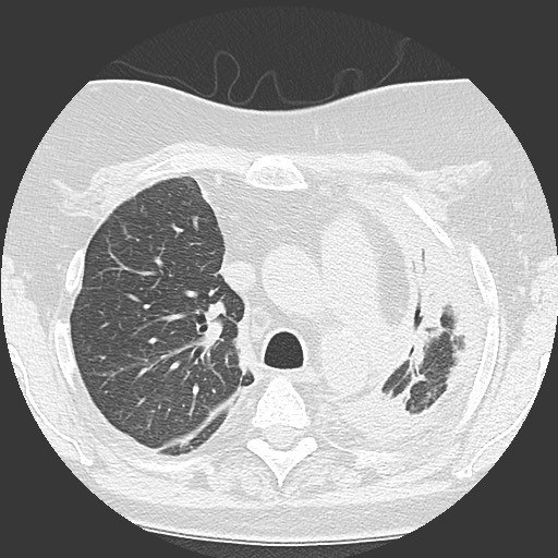 Chronic lung allograft dysfunction - restrictive form (Radiopaedia 60595-68316 Axial lung window 23).jpg