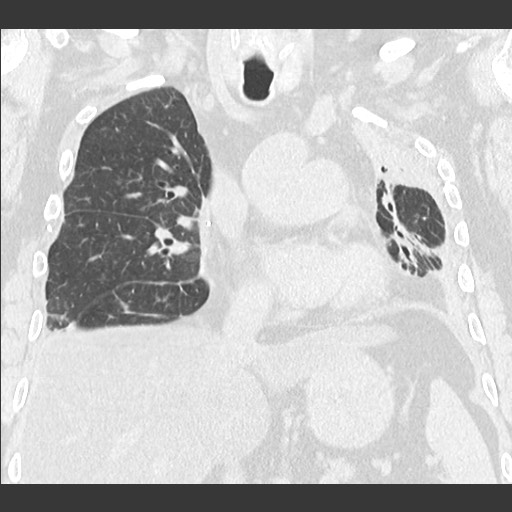 File:Chronic lung allograft dysfunction - restrictive form (Radiopaedia 60595-68316 Coronal lung window 52).jpg