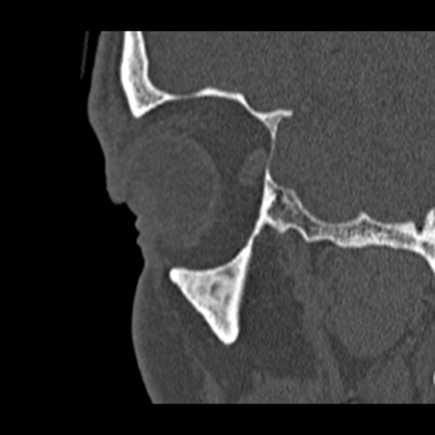 Chronic maxillary sinusitis (Radiopaedia 27879-28116 Sagittal bone window 3).jpg