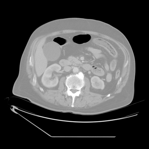 File:Chronic mesenteric ischemia - arterial (Radiopaedia 88205-104810 Axial lung window 9).jpg