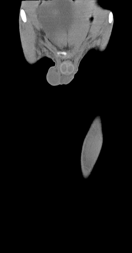 Chronic osteomyelitis (with sequestrum) (Radiopaedia 74813-85822 E 5).jpg