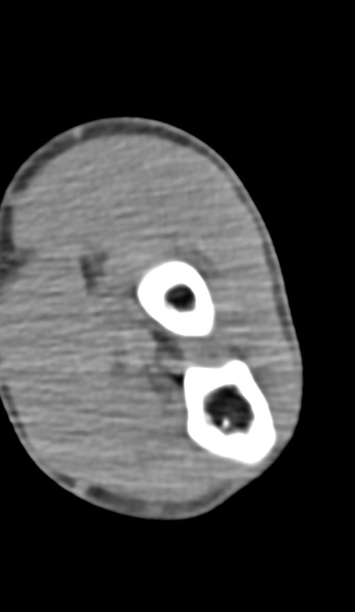 Chronic osteomyelitis of the distal humerus (Radiopaedia 78351-90971 Axial non-contrast 110).jpg