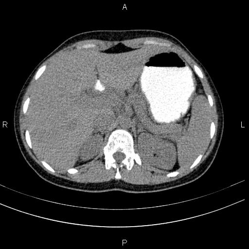Chronic pancreatitis (Radiopaedia 64576-73450 Axial non-contrast 32).jpg