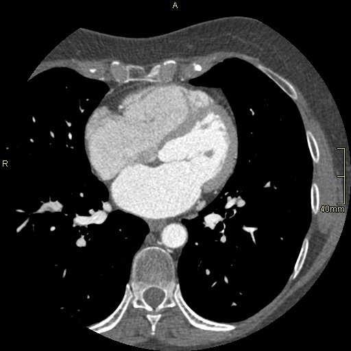 Chronic pulmonary embolism (Radiopaedia 73073-85094 Axial C+ CTPA 94).jpg