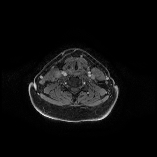 Chronic submandibular sialadenitis (Radiopaedia 61852-69885 Axial T1 C+ fat sat 26).jpg