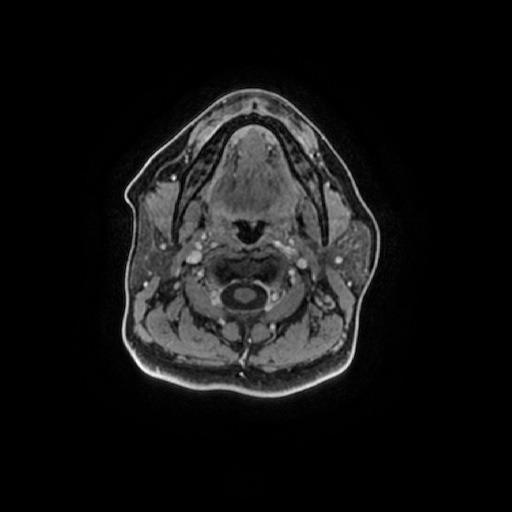 Chronic submandibular sialadenitis (Radiopaedia 61852-69885 Axial T1 C+ fat sat 72).jpg