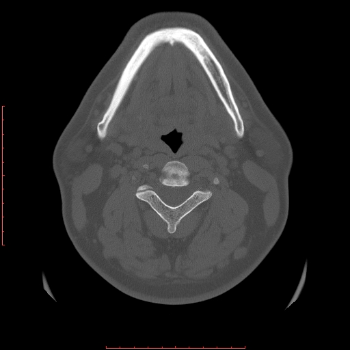 Chronic submandibular sialolithiasis (Radiopaedia 69817-79814 Axial bone window 76).jpg