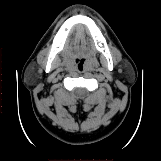 Chronic submandibular sialolithiasis (Radiopaedia 69817-79814 Axial non-contrast 85).jpg