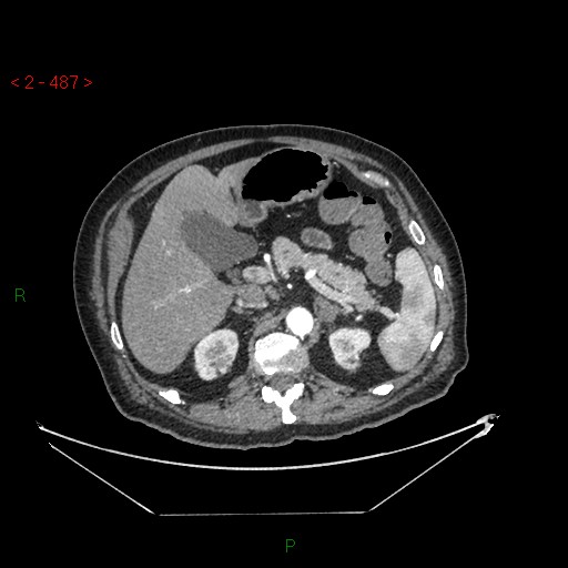Circumaortic left renal vein and doubled left renal arteries (Radiopaedia 52268-58158 A 23).jpg
