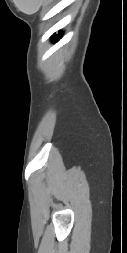 Circumaortic left renal vein with a duplicated retroaortic vein (Radiopaedia 91668-109398 C 120).jpg