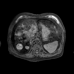 Cirrhosis and hepatocellular carcinoma in the setting of hemochromatosis (Radiopaedia 75394-86594 Axial T1 C+ fat sat 49).jpg