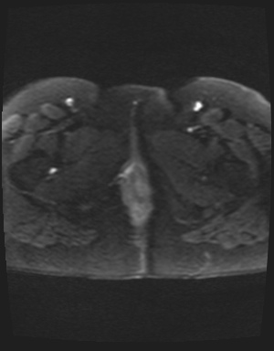 File:Class II Mullerian duct anomaly- unicornuate uterus with rudimentary horn and non-communicating cavity (Radiopaedia 39441-41755 Axial DWI 29).jpg