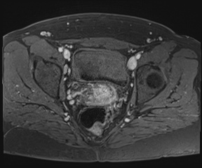 File:Class II Mullerian duct anomaly- unicornuate uterus with rudimentary horn and non-communicating cavity (Radiopaedia 39441-41755 Axial T1 fat sat 84).jpg