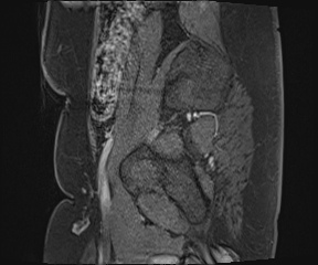 File:Class II Mullerian duct anomaly- unicornuate uterus with rudimentary horn and non-communicating cavity (Radiopaedia 39441-41755 G 115).jpg