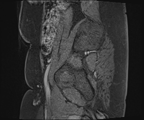 File:Class II Mullerian duct anomaly- unicornuate uterus with rudimentary horn and non-communicating cavity (Radiopaedia 39441-41755 G 117).jpg