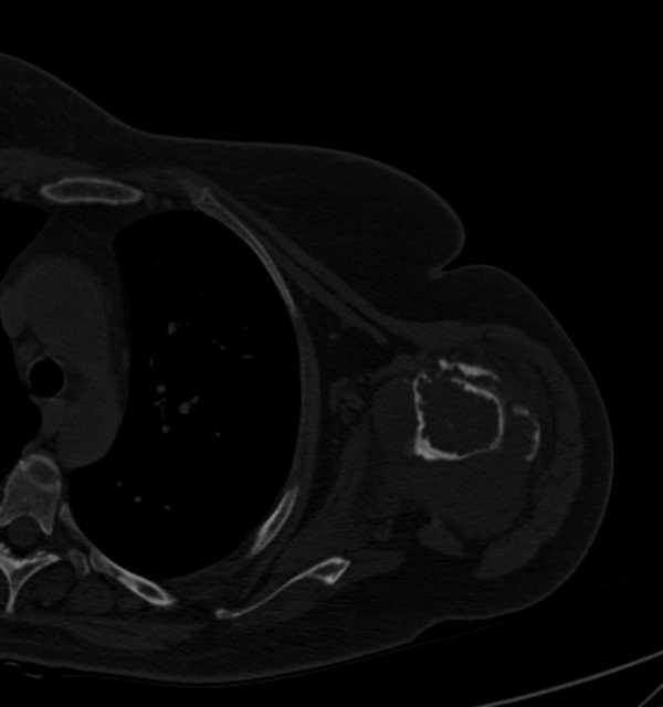 Clear cell chondrosarcoma - humerus (Radiopaedia 63104-71612 Axial bone window 59).jpg