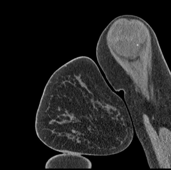 Clear cell chondrosarcoma - humerus (Radiopaedia 63104-71612 D 9).jpg