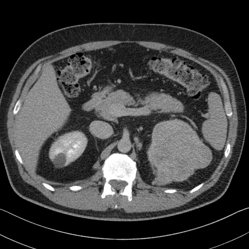 File:Clear cell renal cell carcinoma (Radiopaedia 61449-69393 H 19).jpg