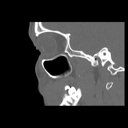 File:Cleft hard palate and alveolus (Radiopaedia 63180-71710 Sagittal bone window 36).jpg