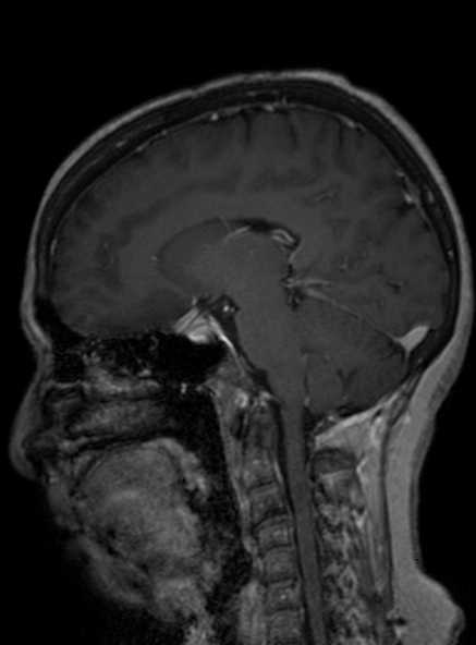 Clival meningioma (Radiopaedia 53278-59248 Sagittal T1 C+ 241).jpg