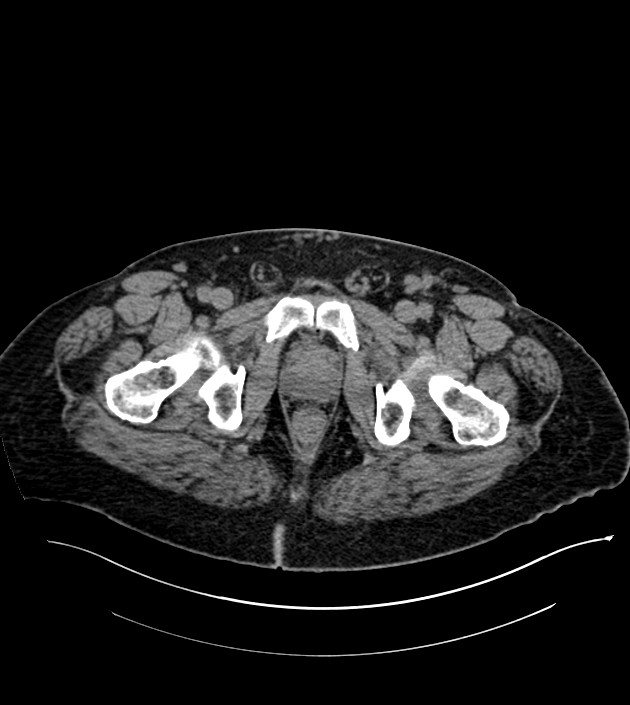 Closed-loop small bowel obstruction-internal hernia (Radiopaedia 78439-91096 Axial non-contrast 155).jpg