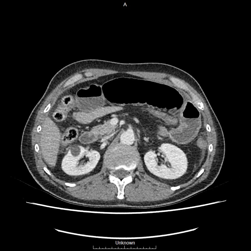 Closed loop bowel obstruction and ischemia (Radiopaedia 86959-103180 A 24).jpg