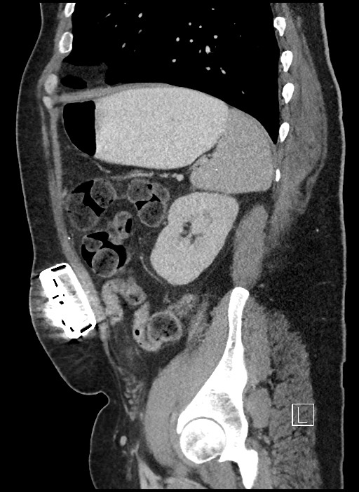 Closed loop obstruction - internal hernia into nephrectomy bed (Radiopaedia 59867-67320 C 17).jpg