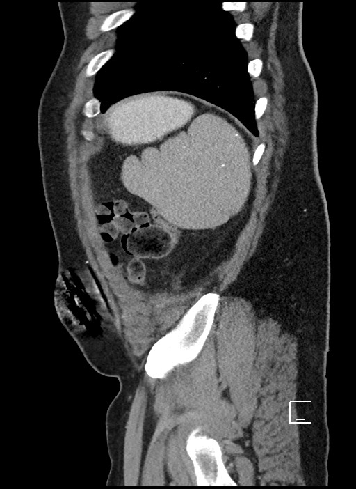 Closed loop obstruction - internal hernia into nephrectomy bed (Radiopaedia 59867-67320 C 5).jpg