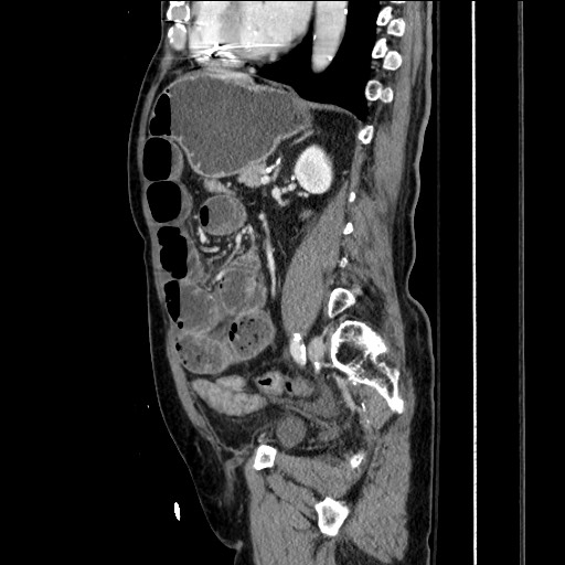 File:Closed loop obstruction due to adhesive band, resulting in small bowel ischemia and resection (Radiopaedia 83835-99023 F 116).jpg
