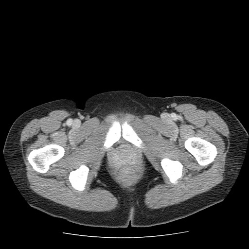 File:Closed loop small bowel obstruction (Radiopaedia 65403-74451 Axial 72).jpg