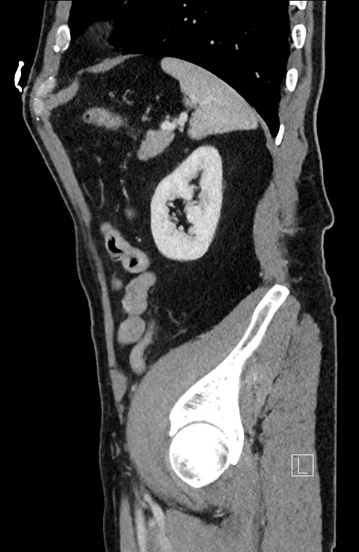 Closed loop small bowel obstruction - internal hernia (Radiopaedia 57806-64778 C 29).jpg