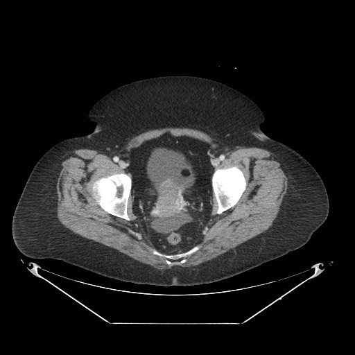 Closed loop small bowel obstruction - internal hernia (Radiopaedia 65402-74450 A 121).jpg