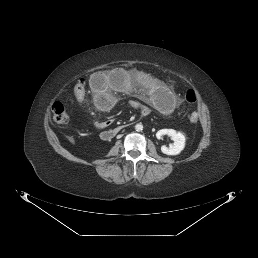 Closed loop small bowel obstruction - internal hernia (Radiopaedia 65402-74450 A 64).jpg
